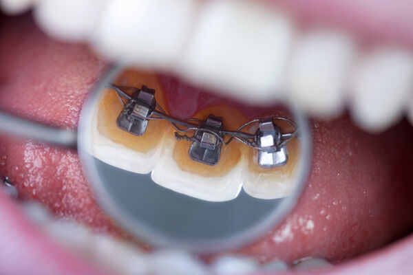 Lingual Braces