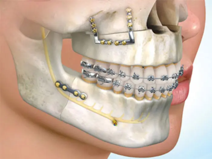 Surgical Orthodontics